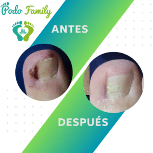 Matricectomía Química