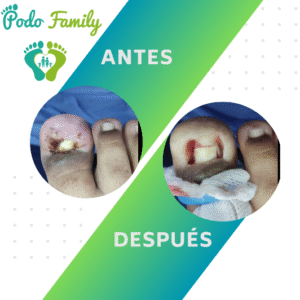 Onicocriptosis o uñeros